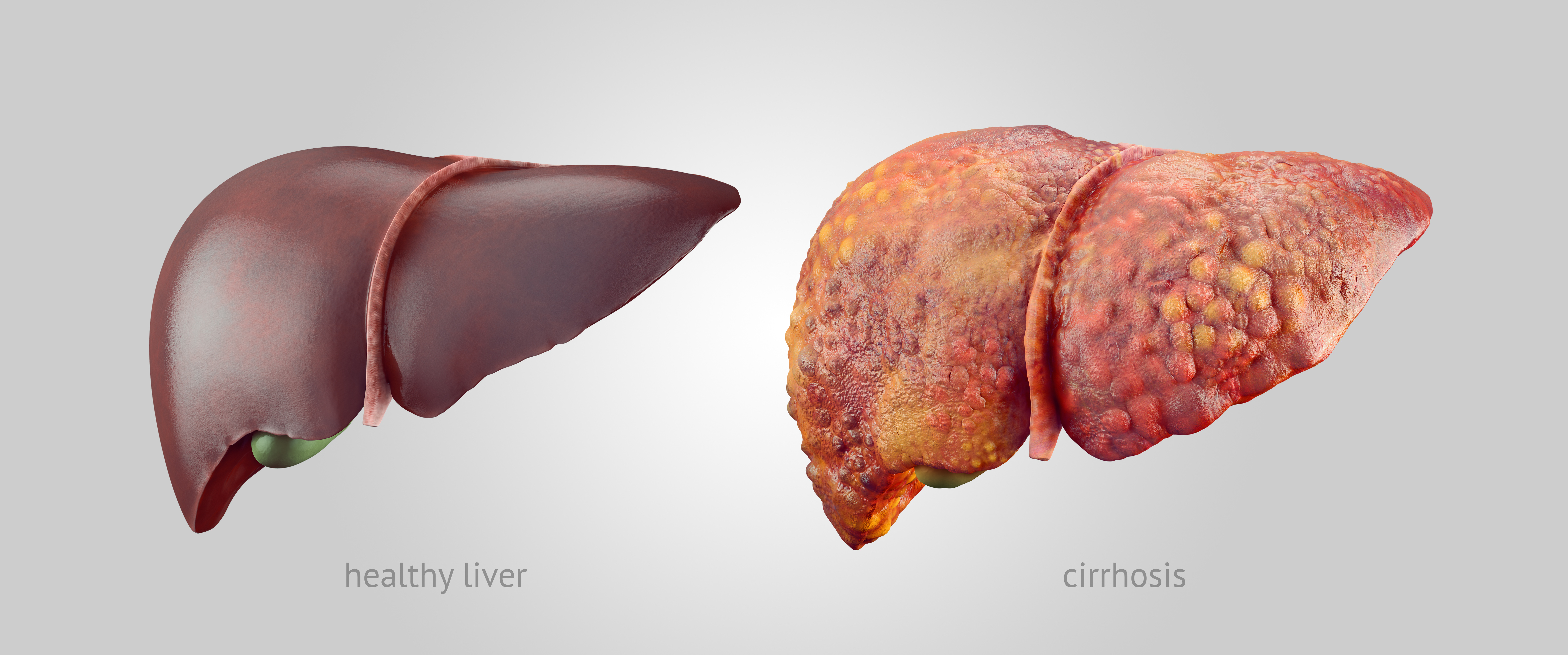Realistic illustration of healthy and sick human livers